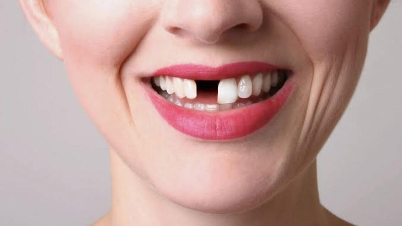 Ağızda eksik bir diş tüm vücudu etkiliyor! Uzmandan hayati uyarılar