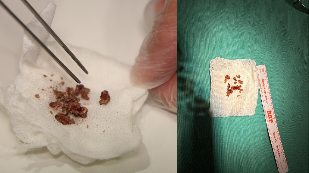 Estetik ameliyatta ortaya çıktı: Siz de burnunuzda bu taşlarla yaşıyor olabilirsiniz!