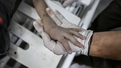 İsrail'in Gazze Şifa Hastanesi saldırısından sağ kurtuldu! Vücudunun %70'i yandı