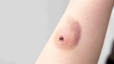 Kene tehdidi büyüyor: Kırım Kongo Kanamalı ateşine karşı alınması gereken önlemler