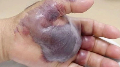 Et yiyen bakteri Türkiye'de görüldü mü? Bakanlıktan açıklama geldi