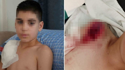 Çocuğa köpek saldırısı! Omzunu kaptı, sağ kolu felç oldu