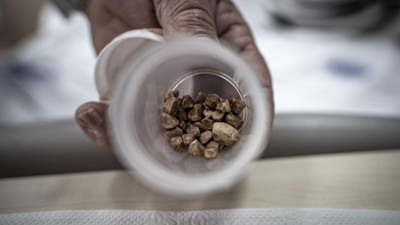 Erzurum'da bir kadının idrar kanalından 51 taş çıkarıldı