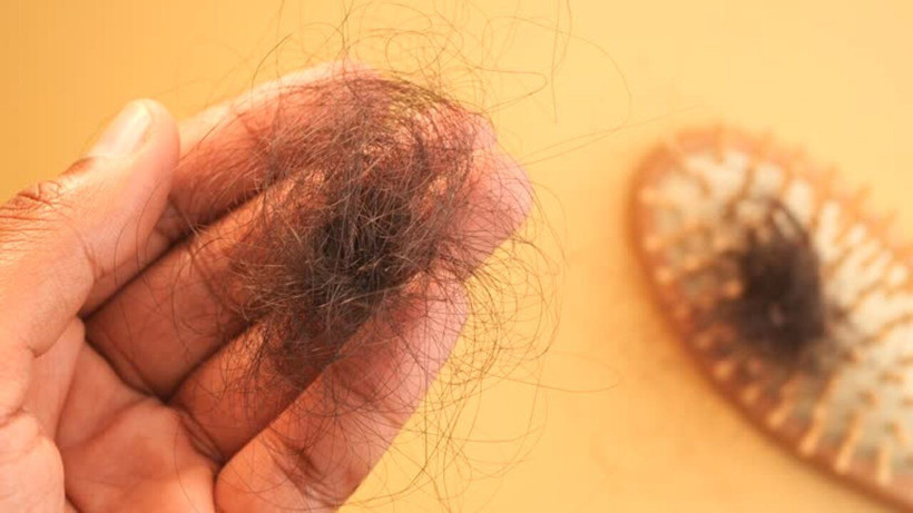 Dökülen saçlara son! 2 haftada saç dökülmesini bitiriyor, saçları kalınlaştırıyor - Resim: 7